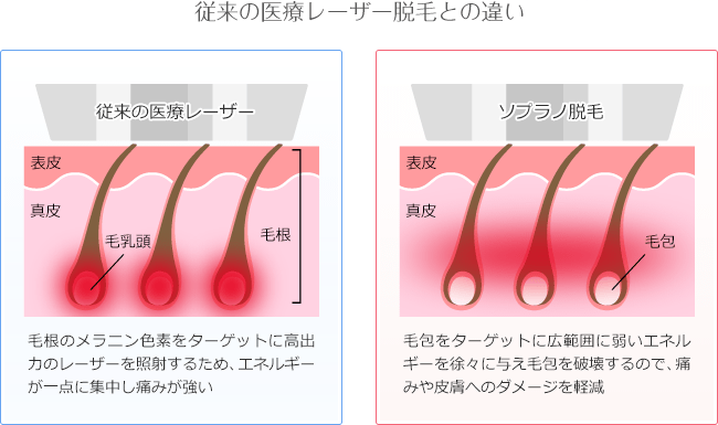 ソプラノチタニウムと従来レーザー脱毛の違い図解
