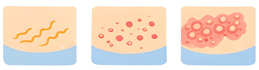 症状：痛み、発疹、水ぶくれ